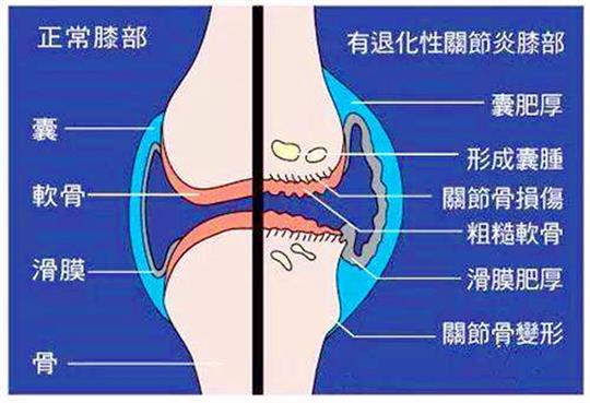 有这6点说明膝关节出问题了，“三字经”帮您缓解